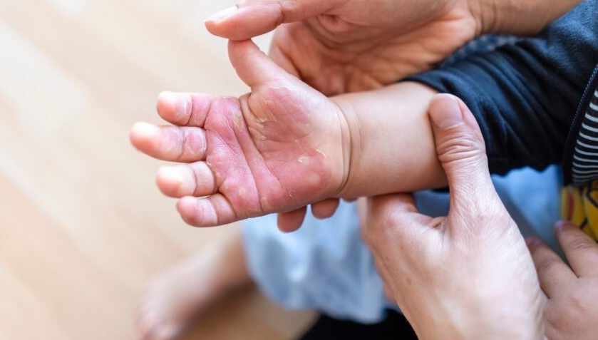 Tùy từng loại tai nạn thương tích ở trẻ mà người lớn có thể áp dụng cách sơ cứu khác nhau. Ảnh minh họa
