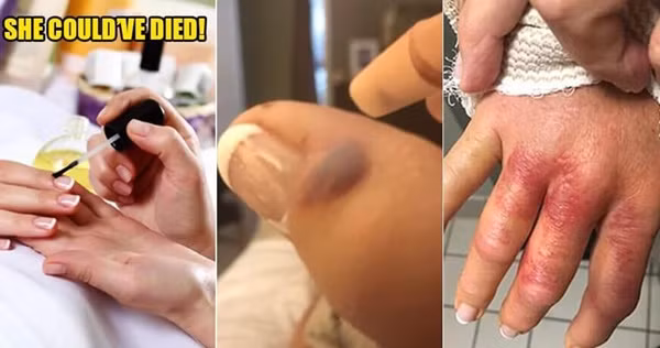 "Vi khuẩn ăn thịt" có thể xâm nhập thông qua một vết xước nhỏ.