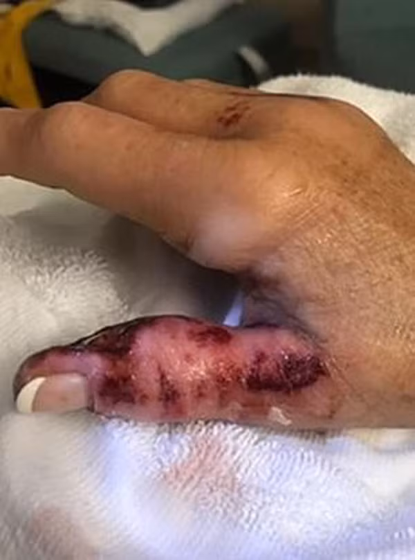 Đi làm móng ở spa, người phụ nữ bị nhiễm vi khuẩn ăn thịt người và phải cắt bỏ 1 phần ngón tay cái-3