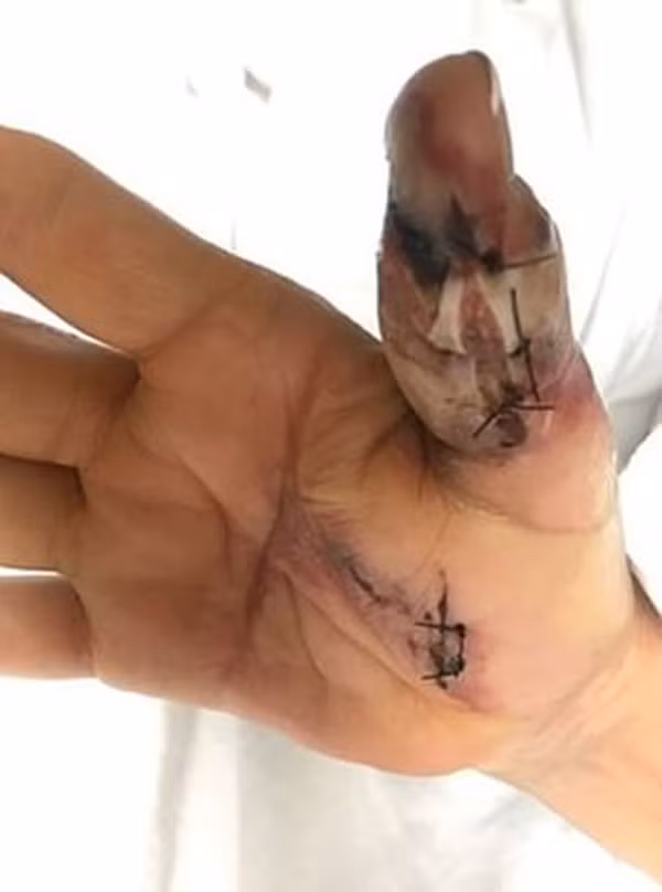 Đi làm móng ở spa, người phụ nữ bị nhiễm vi khuẩn ăn thịt người và phải cắt bỏ 1 phần ngón tay cái-2