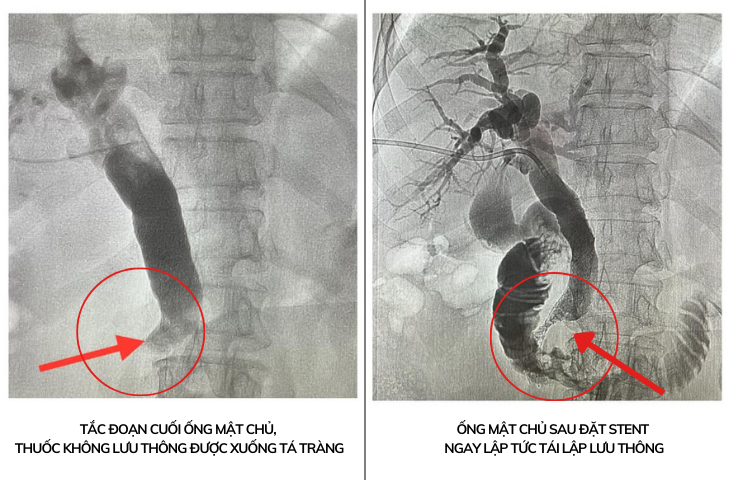 Ống mật chủ của bệnh nhân trước và sau khi được đặt stent Ống mật chủ của bệnh nhân trước và sau khi được đặt stent