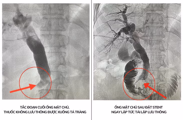 Ống mật chủ của bệnh nhân trước và sau khi được đặt stent