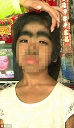 Kỳ dị cô bé 8 tuổi mắc chứng bệnh “người sói” - Ảnh 1 Kỳ dị cô bé 8 tuổi mắc chứng bệnh “người sói” - Ảnh 1