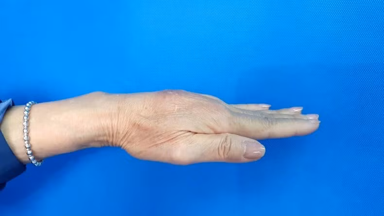 Một trường hợp biến chứng u hạt khi tiêm filler tay. Ảnh: BVCC