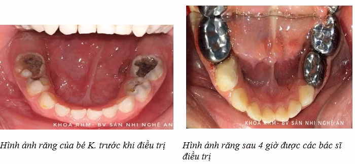 Điều cần làm ngay khi phát hiện răng trẻ có dấu hiệu bất thường ảnh 1
