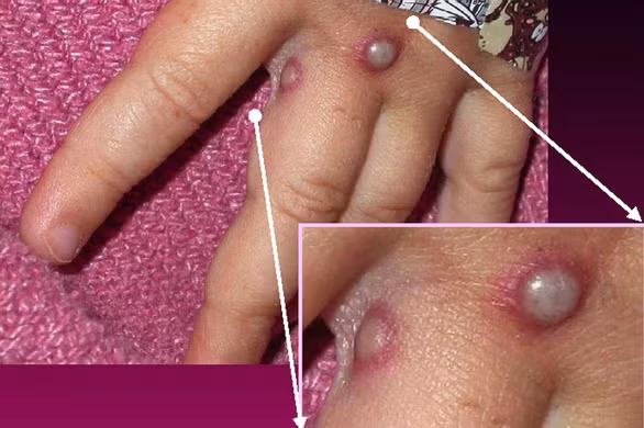 Một trong những triệu chứng của bệnh đậu mùa khỉ. Ảnh: GETTY.