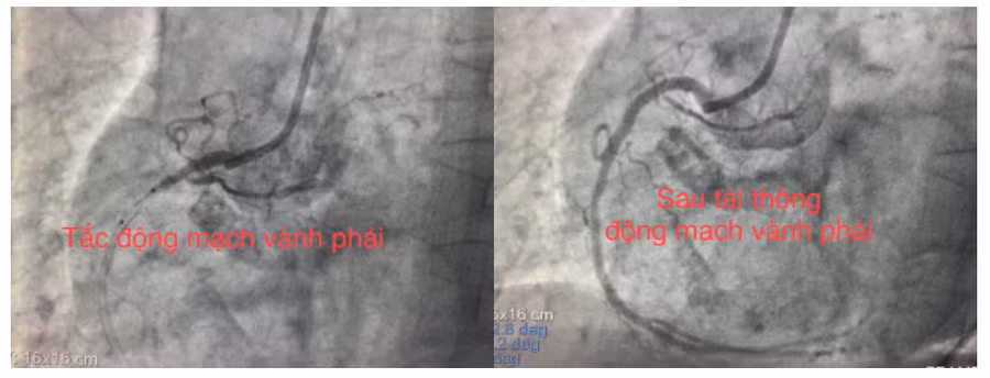 Hình ảnh trước và sau tái thông trên DSA của bệnh nhân N. T. E (ảnh do ê – kíp cung cấp). Nguồn: BV.