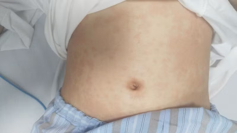 Hình ảnh ban đỏ rải rác toàn thân trẻ. Ảnh: BV.