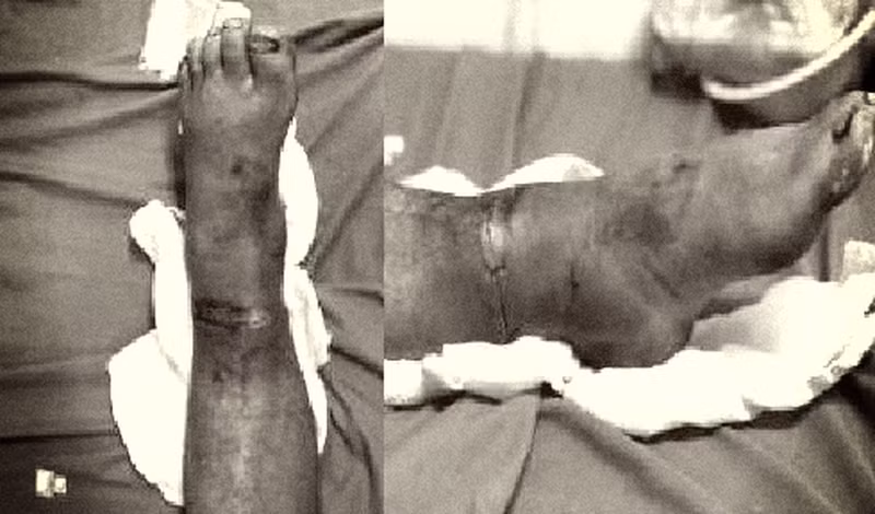 Bàn chân của bệnh nhân sau nối. Ảnh: BV.