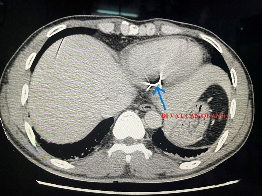 Hình ảnh chụp cắt lớp phát hiện dị vật trong tim bệnh nhân. Ảnh: BV.