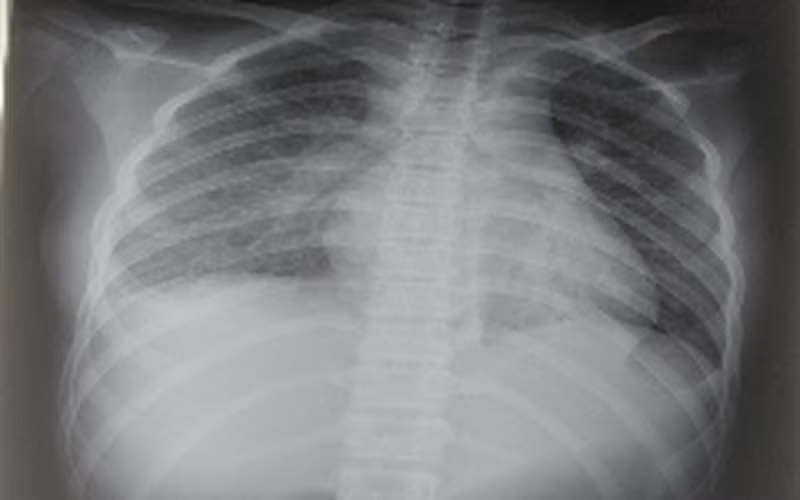 Phim chụp tổn thương phổi của bệnh nhi. Ảnh: BV.