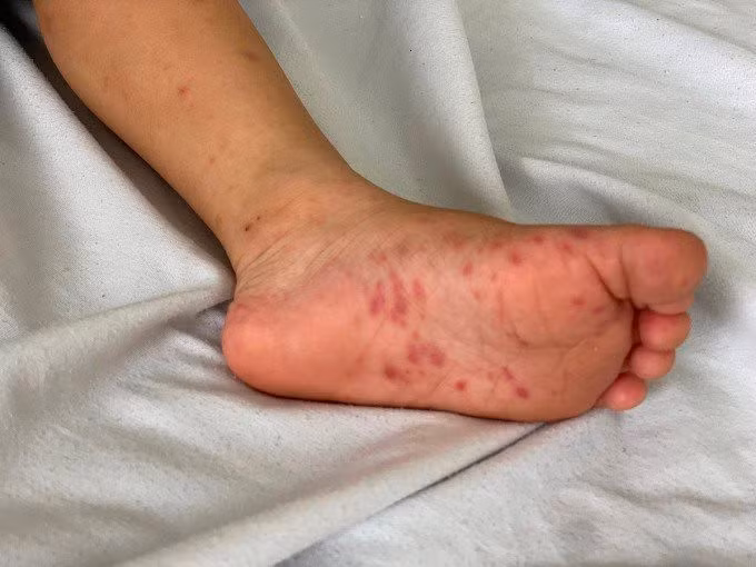 Tay chân miệng là bệnh truyền nhiễm phổ biến ở trẻ em, đặc biệt là bé dưới 5 tuổi. Ảnh minh họa