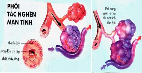 Nguyên nhân và cách điều trị bệnh phổi tắc nghẽn mạn tính