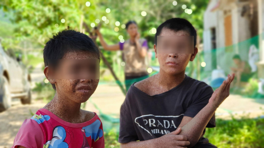 Bệnh khô da sắc tố khiến thân thể em Hà Thị Cúc bị bong tróc, ngứa ngáy.