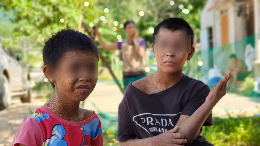 Bệnh khô da sắc tố khiến thân thể em Hà Thị Cúc bị bong tróc, ngứa ngáy.
