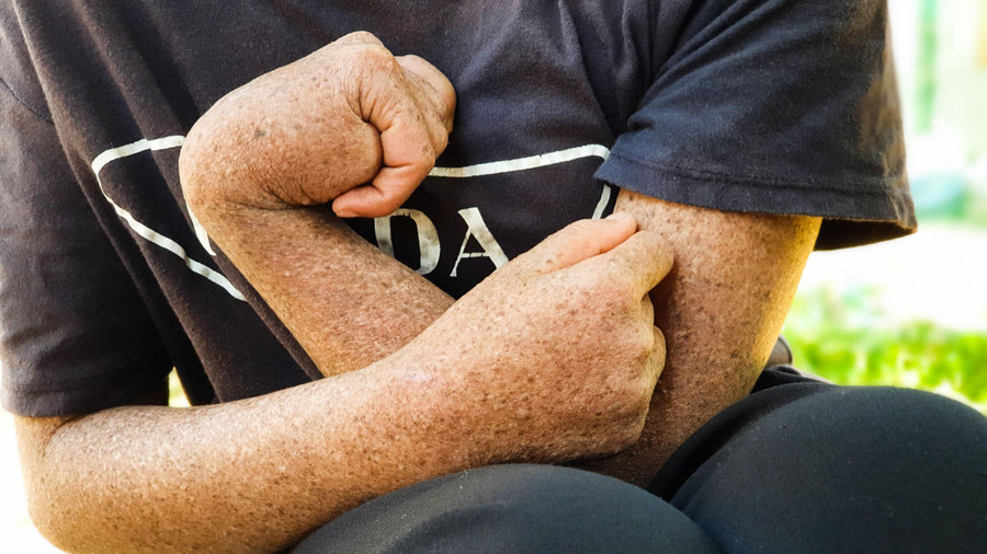 Căn bệnh khiến tay em Nương bị tật, ảnh hưởng đến sinh hoạt.