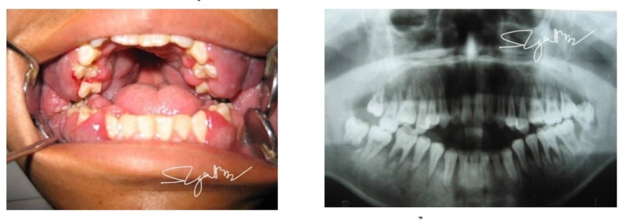 Các bác sĩ chẩn đoán bệnh nhân mắc leucemie cấp (ung thư máu cấp tính). Ảnh: BVCC