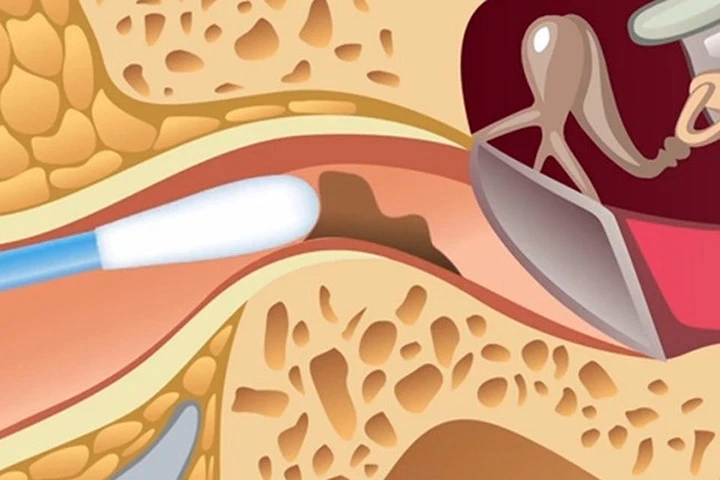 Đây là lý do tại sao bạn không bao giờ được dùng tăm bông để lấy ráy tai