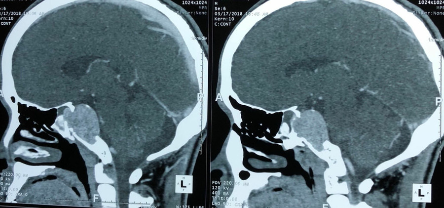 Phim chụp khối u