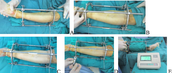 Lắp khung cố định ngoài: Xuyên đinh Kirschner qua đầu trên xương chày (A); Xuyên đinh Kirschner qua đầu dưới xương chày và nằm dưới đầu đinh SIGN (B); Xuyên 2 đinh Kirschner qua đầu trên và đầu dưới xương chày (C); căng các đinh Kirschner (D,E). Ảnh: Bác sĩ cung cấp Lắp khung cố định ngoài: Xuyên đinh Kirschner qua đầu trên xương chày (A); Xuyên đinh Kirschner qua đầu dưới xương chày và nằm dưới đầu đinh SIGN (B); Xuyên 2 đinh Kirschner qua đầu trên và đầu dưới xương chày (C); căng các đinh Kirschner (D,E).