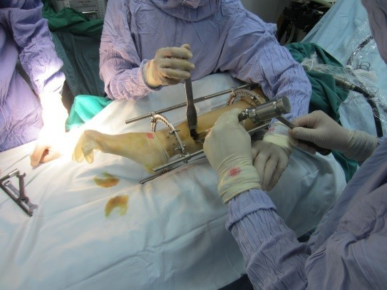 Kéo dài chân: 3 bước đóng đinh, định hình, cắt xương