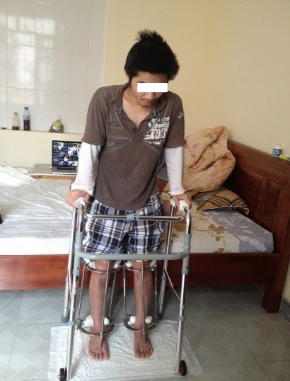 Bệnh nhân tập tì nén một phần trong khung tại nhà. Ảnh: Bác sĩ cung cấp Kéo dài chân: 3 bước đóng đinh, định hình, cắt xương