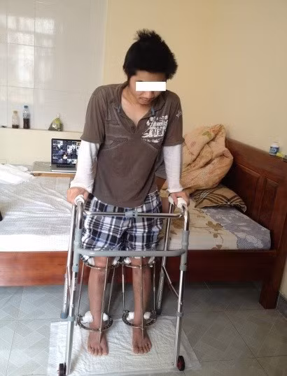 Bệnh nhân tập tì nén một phần trong khung tại nhà. Ảnh: Bác sĩ cung cấp Kéo dài chân: 3 bước đóng đinh, định hình, cắt xương