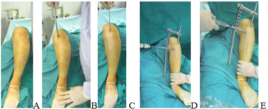 Rạch da (A); Dùi lỗ vào (B); Khoan ống tủy (C); Đóng đinh SIGN, khoan lỗ bắt vít chốt trung tâm (D); Bắt vít chốt trung tâm (E). Ảnh: Bác sĩ cung cấp Đóng đinh SIGN và bắt 2 vít chốt trung tâm: Rạch da (A); Dùi lỗ vào (B); Khoan ống tủy (C) ; Đóng đinh SIGN, khoan lỗ bắt vít chốt trung tâm (D); Bắt vít chốt trung tâm (E).