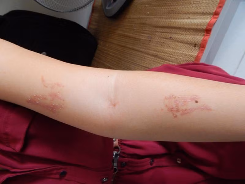 Vết thương do kiến ba khoang gây ra có thể để lại sẹo.