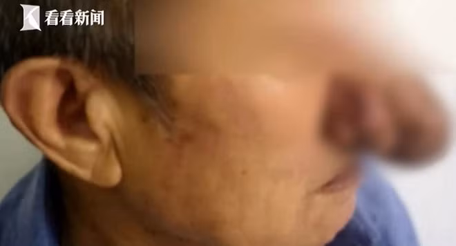 Mũi ông Trương bị phì đại. Ảnh: TVBS.