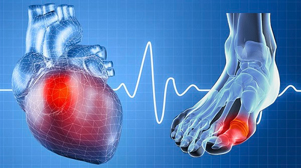 Bệnh gút gây biến chứng nguy hiểm, ảnh hưởng tới huyết áp, tim mạch, thận… Ảnh: ITN Bệnh gút gây biến chứng nguy hiểm, ảnh hưởng tới huyết áp, tim mạch, thận… Ảnh: ITN