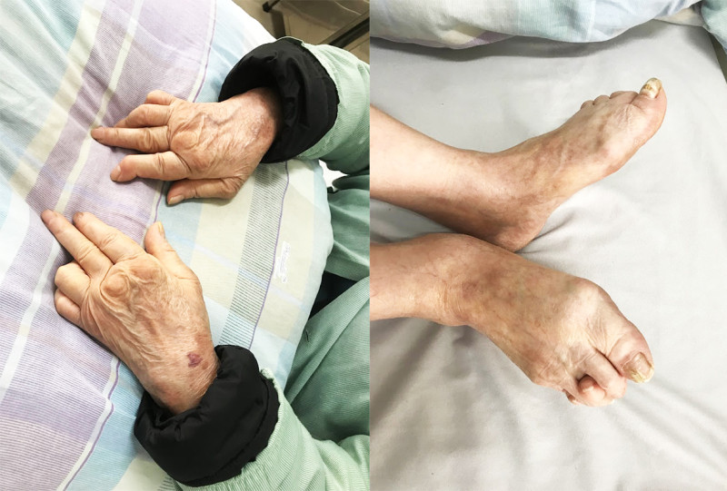 Bàn tay, bàn chân của bệnh nhân viêm khớp dạng thấp bị biến dạng nặng nề. Ảnh: BVCC Bàn tay, bàn chân của bệnh nhân viêm khớp dạng thấp bị biến dạng nặng nề. Ảnh: BVCC