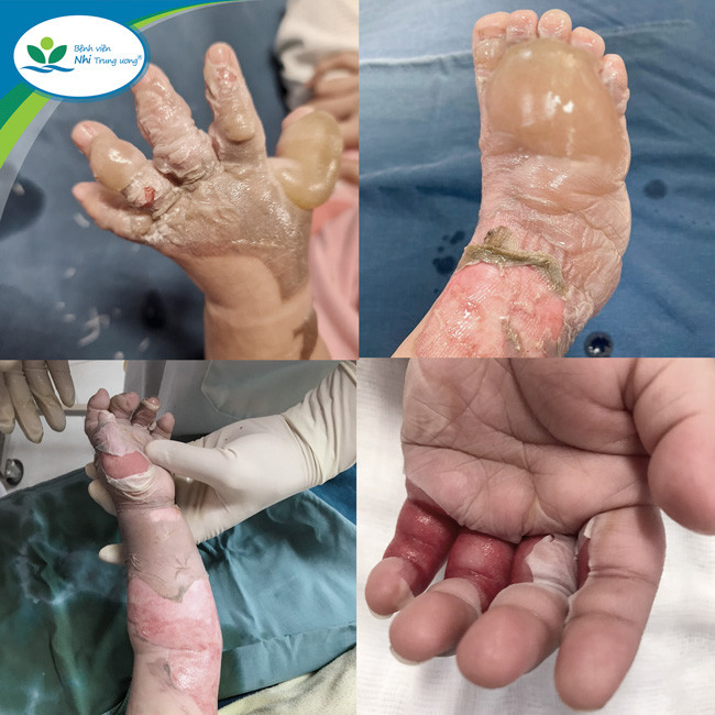 Xử trí đúng ngay sau bỏng làm giảm diện tích, độ sâu bỏng, làm diễn tiến bệnh nhẹ hơn, giảm tỷ lệ tử vong, hạn chế di chứng. Ảnh BVCC.