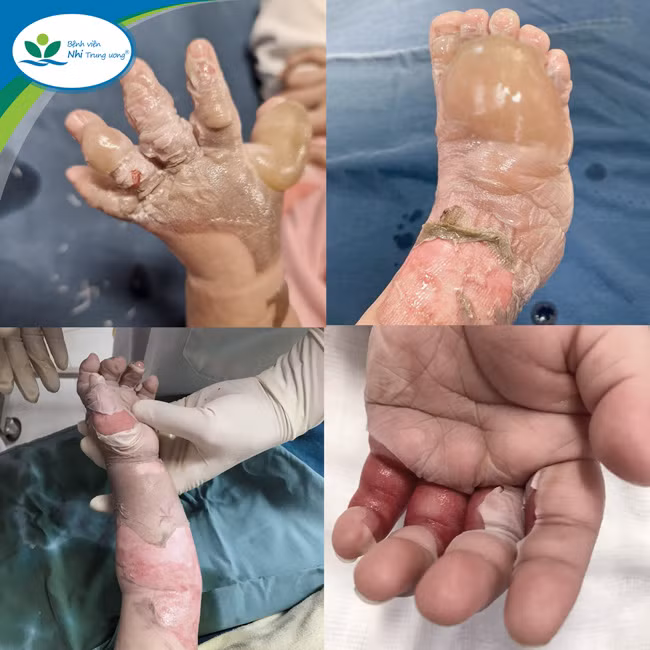 Xử trí đúng ngay sau bỏng làm giảm diện tích, độ sâu bỏng, làm diễn tiến bệnh nhẹ hơn, giảm tỷ lệ tử vong, hạn chế di chứng. Ảnh BVCC.