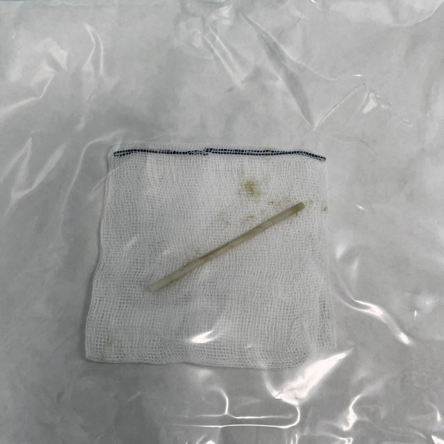 Bé gái nuốt cả cây kẹo mút vì giật mình ảnh 1 Bé gái nuốt cả cây kẹo mút vì giật mình ảnh 1