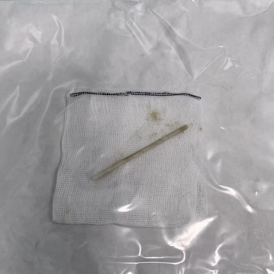 Bé gái nuốt cả cây kẹo mút vì giật mình ảnh 1