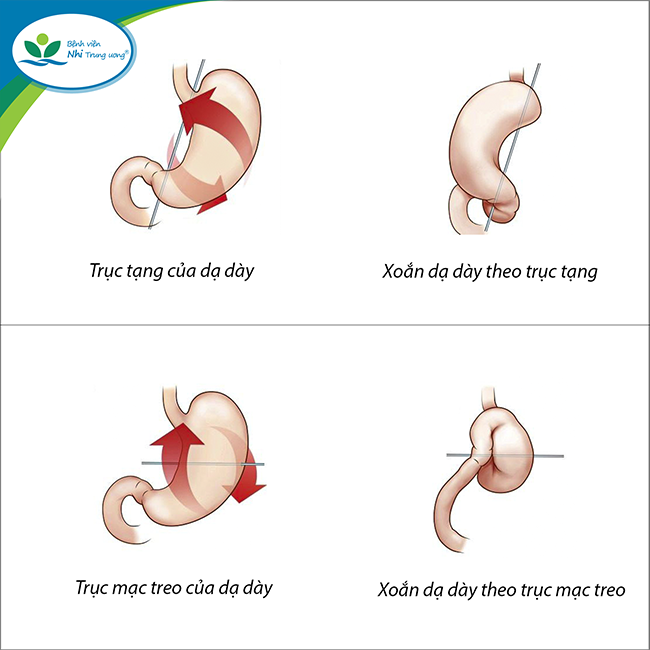 Hình ảnh xoắn dạ dày theo trục tạng và trục mạc treo. Hình ảnh xoắn dạ dày theo trục tạng và trục mạc treo.