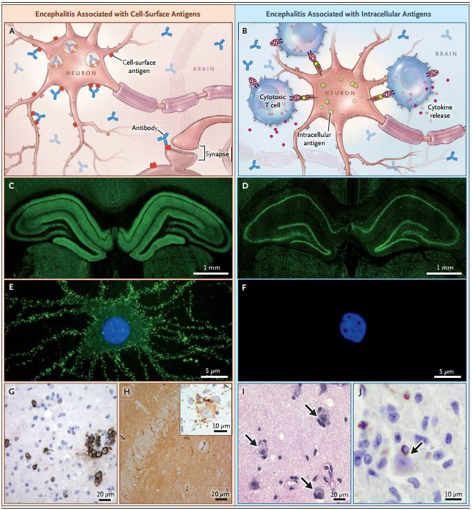 Viêm não tự miễn liên quan tới kháng thể bề mặt (bên trái) và kháng thể nội bào (bên phải). Viêm não tự miễn liên quan tới kháng thể bề mặt (bên trái) và kháng thể nội bào (bên phải).