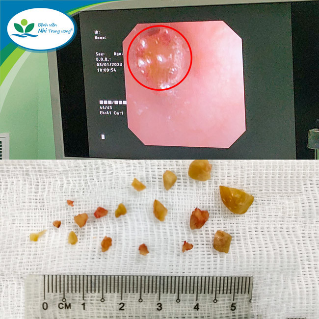 Hình ảnh hạt lạc mắc trong phế quản và được gắp ra ngoài sau khi phá thành nhiều mảnh nhỏ. Ảnh: BV.