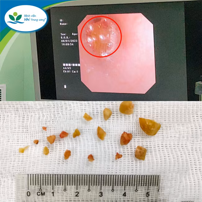 Hình ảnh hạt lạc mắc trong phế quản và được gắp ra ngoài sau khi phá thành nhiều mảnh nhỏ. Ảnh: BV.