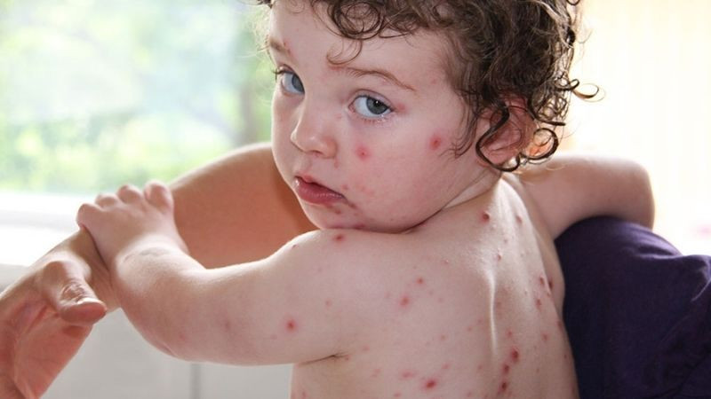 Thủy đậu thường có biểu hiện là bóng nước nổi khắp cơ thể kể cả vùng niêm mạc như miệng, hậu môn. Thủy đậu thường có biểu hiện là bóng nước nổi khắp cơ thể kể cả vùng niêm mạc như miệng, hậu môn.