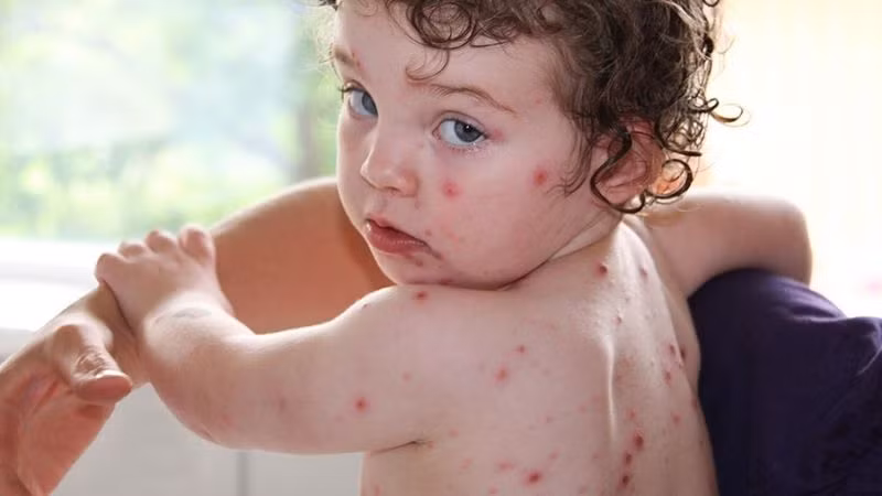 Thủy đậu thường có biểu hiện là bóng nước nổi khắp cơ thể kể cả vùng niêm mạc như miệng, hậu môn.