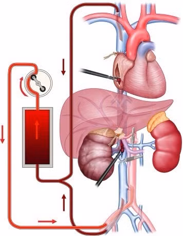 Hình mô phỏng kỹ thuật kẹp tĩnh mạch chủ bụng lấy chồi bướu dưới sự hỗ trợ của hệ thống tuần hoàn ngoài cơ thể. Ảnh: BV.