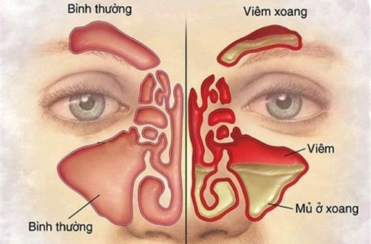 Dấu hiệu nhận biết bệnh viêm xoang và cách phòng tránh ảnh 1 Dấu hiệu nhận biết bệnh viêm xoang và cách phòng tránh ảnh 1