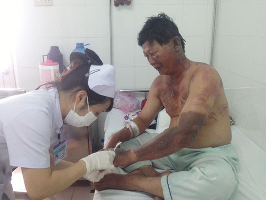 Bị bỏng nặng do vừa lấy xăng vừa hút thuốc