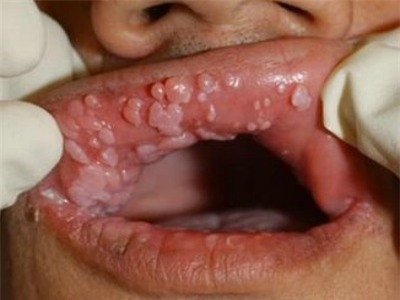 bệnh lậu và những biến chứng nguy hiểm