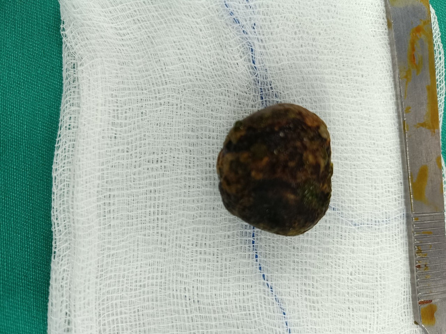 Viên sỏi kích thước lớn 3 cm rơi từ túi mật sang tá tràng Viên sỏi kích thước lớn 3 cm rơi từ túi mật sang tá tràng