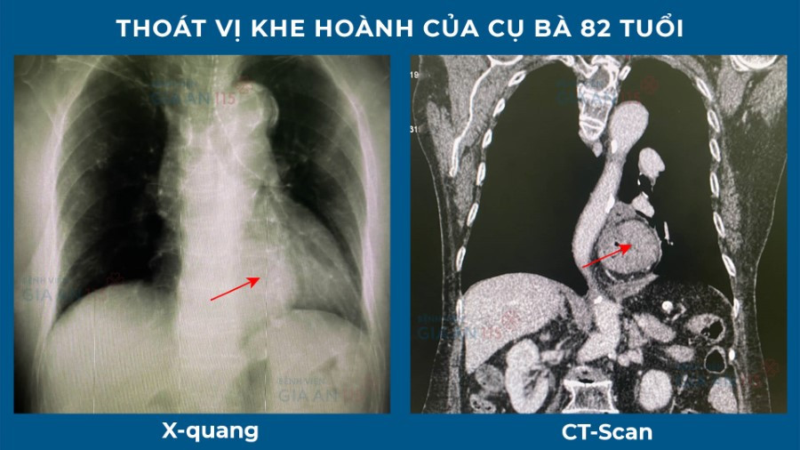 Thoát vị khe hành ở bệnh nhân 82 tuổi. Ảnh: BVCC.