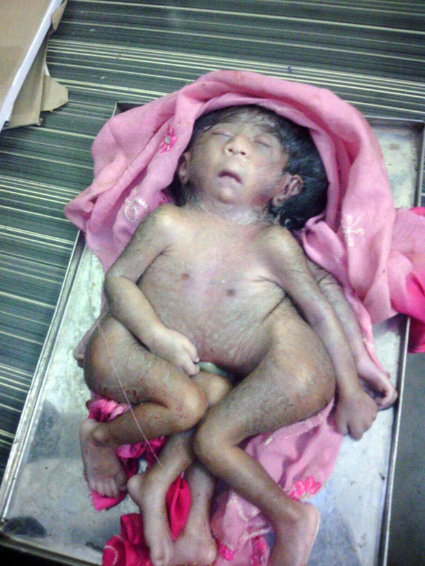 Bé sơ sinh ở Ấn Độ có 4 tay, 4 chân được xem như hiện thân của thần Hindu Bé sơ sinh ở Ấn Độ có 4 tay, 4 chân được xem như hiện thân của thần Hindu