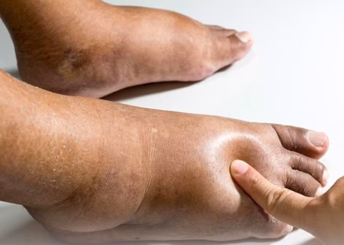 Một trong những biểu hiện của biến chứng bệnh tiểu đường. Ảnh minh họa.